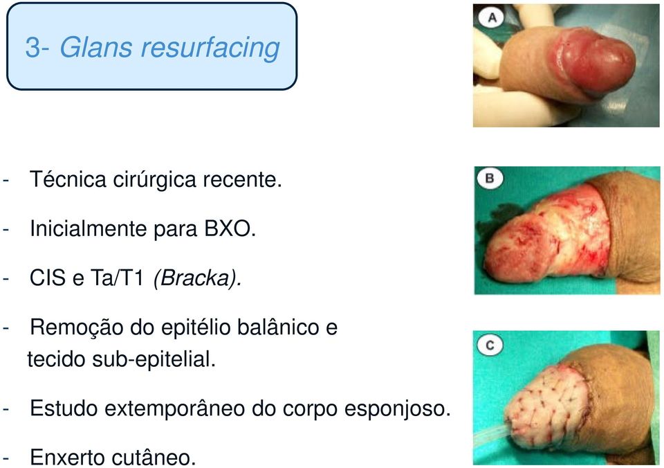 - Remoção do epitélio balânico e tecido sub-epitelial.