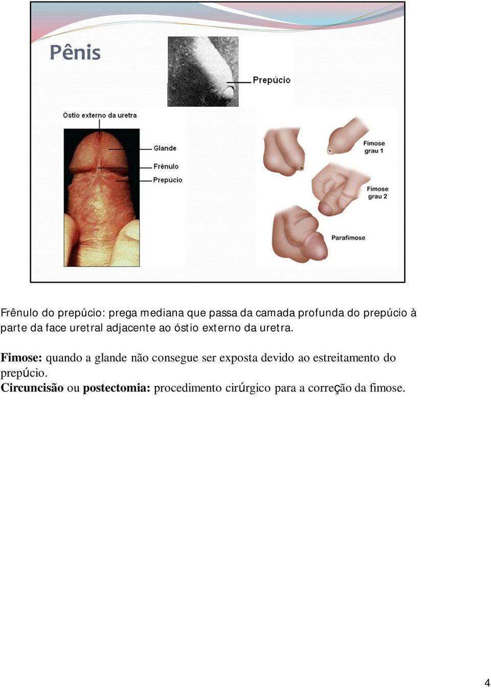 Fimose: quando a glande não consegue ser exposta devido ao estreitamento do