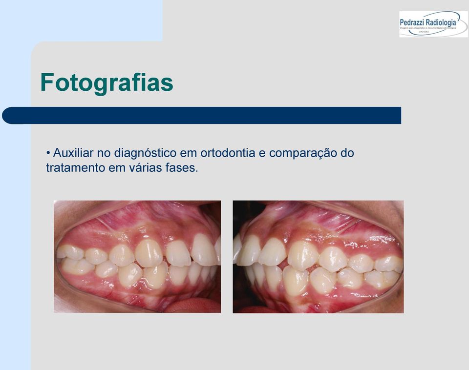 ortodontia e comparação