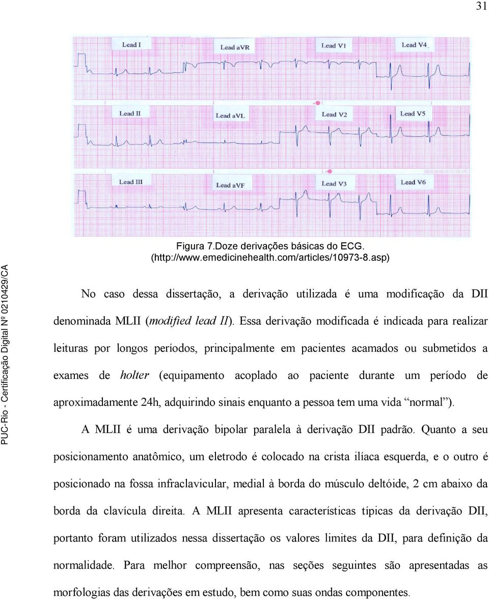 Essa derivação modificada é indicada para realizar leituras por longos períodos, principalmente em pacientes acamados ou submetidos a exames de holter (equipamento acoplado ao paciente durante um