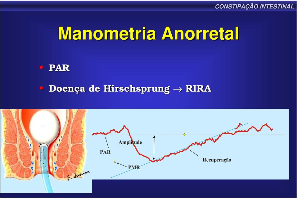 Hirschsprung RIRA