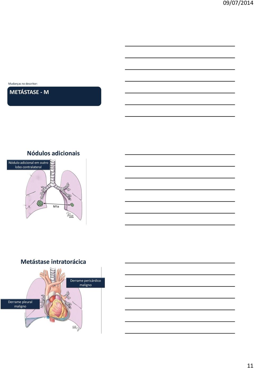 contralateral Metástase intratorácica