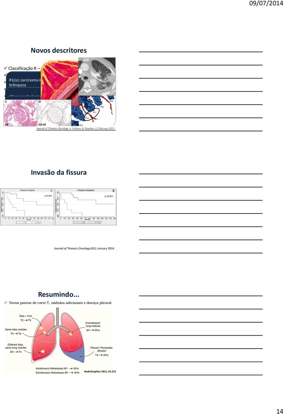 de linfonodos pt3b: ou linfonodo Invasão mediastinal da fáscia endotorácica alto+ cli0: ausência de evidencia radiológica pt3c: cli1: linfangite invasão próxima de costela ao tumor primário cli2: