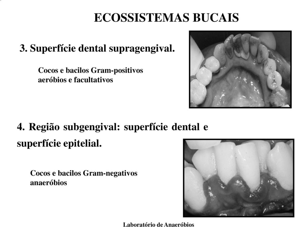 4. Região subgengival: superfície dental e superfície
