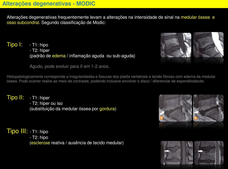 Histopatologicamente corresponde a irregularidades e fissuras dos platôs vertebrais e tecido fibroso com edema da medular óssea.