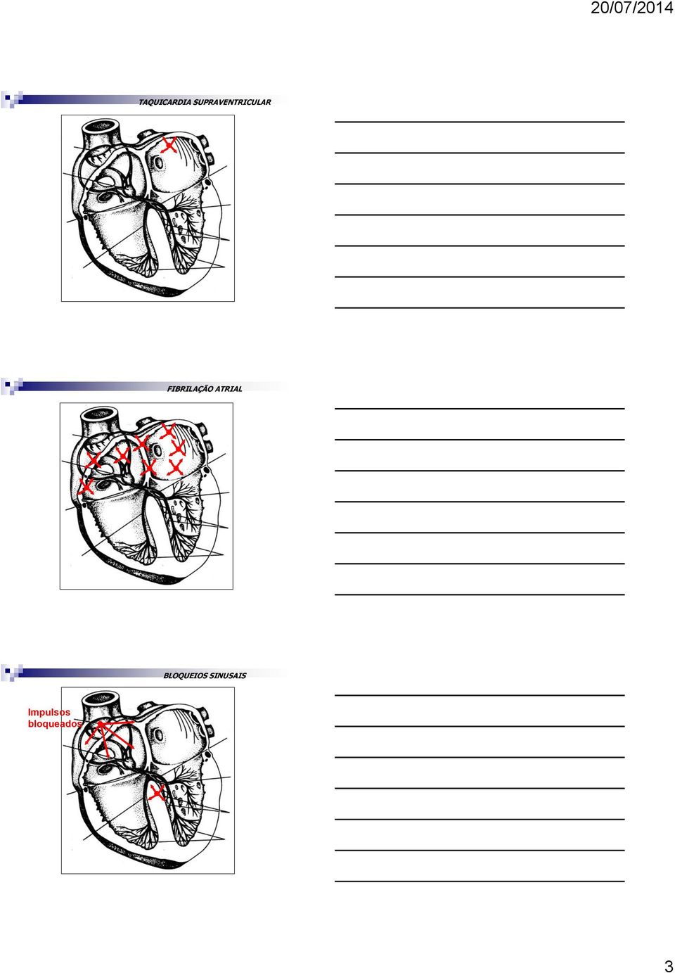 FIBRILAÇÃO ATRIAL