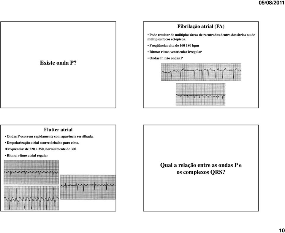 Freqüência: alta de 160 180 bpm Ritmo: ritmo ventricular irregular Ondas P: não ondas P Flutter atrial Ondas P