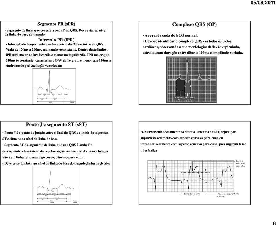 IPR maior que 210ms (e constante) caracteriza o BAV do 1o grau, e menor que 120ms a síndrome de pré-excitação ventricular. Complexo QRS (OP) A segunda onda do ECG normal.