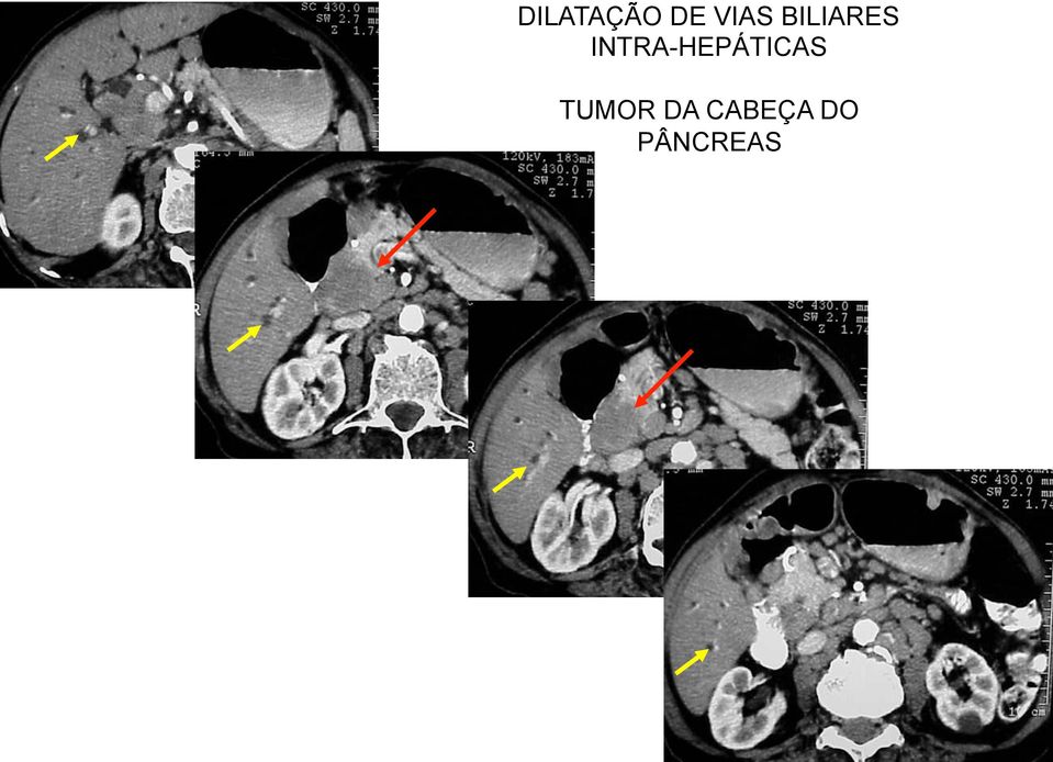 INTRA-HEPÁTICAS