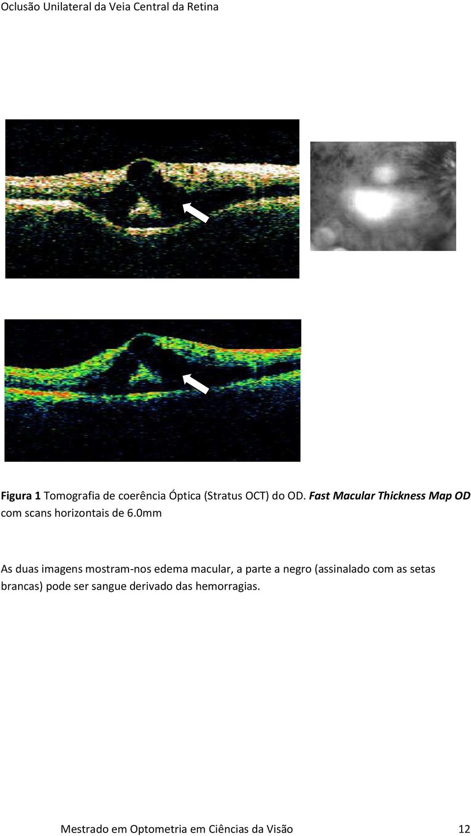 0mm As duas imagens mostram-nos edema macular, a parte a negro (assinalado