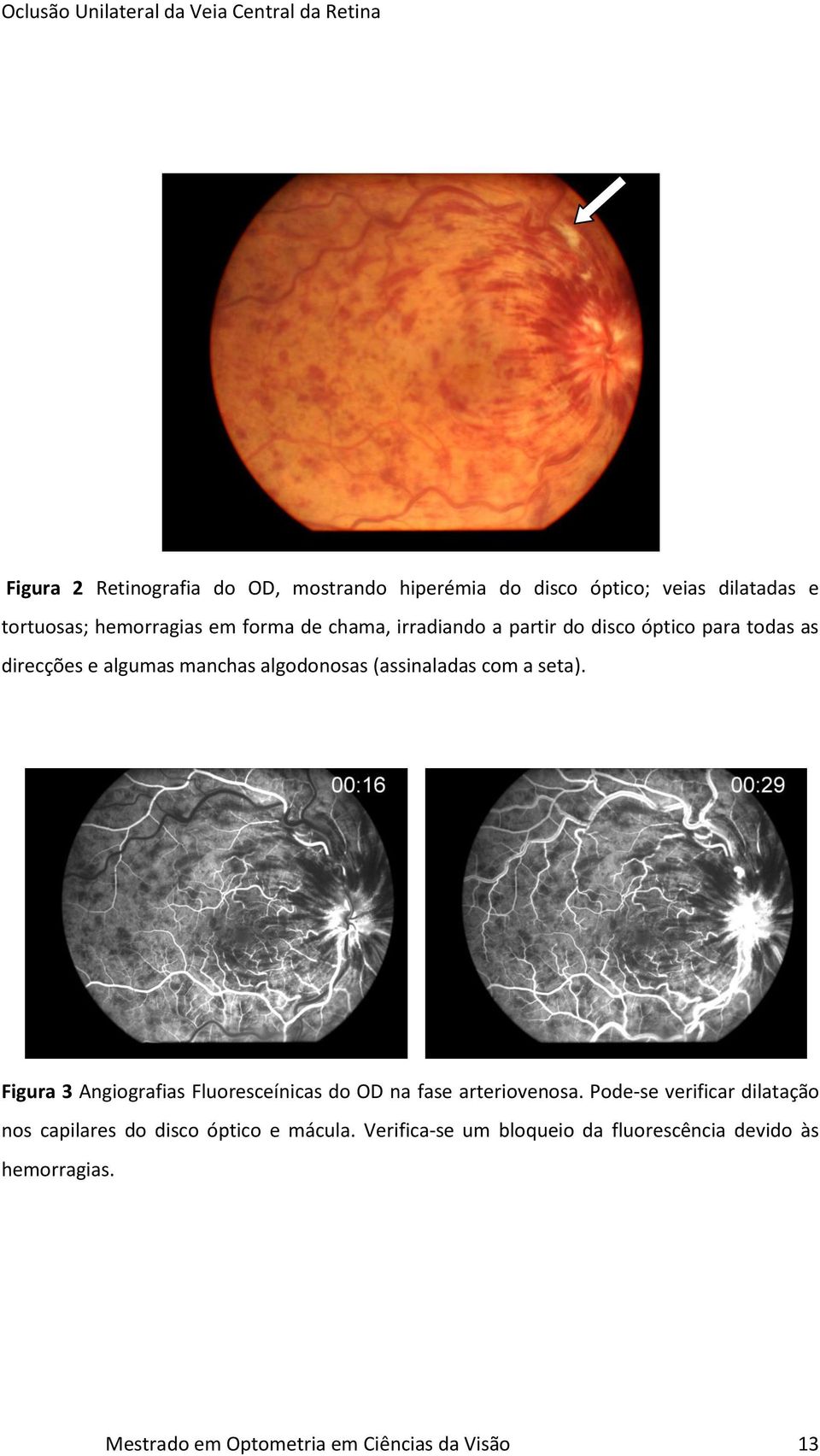 Figura 3 Angiografias Fluoresceínicas do OD na fase arteriovenosa.