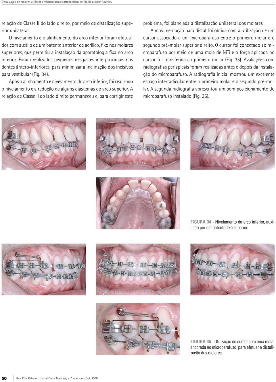 inferior. Foram realizados pequenos desgastes interproximais nos dentes ântero-inferiores, para minimizar a inclinação dos incisivos para vestibular (Fig. 34).