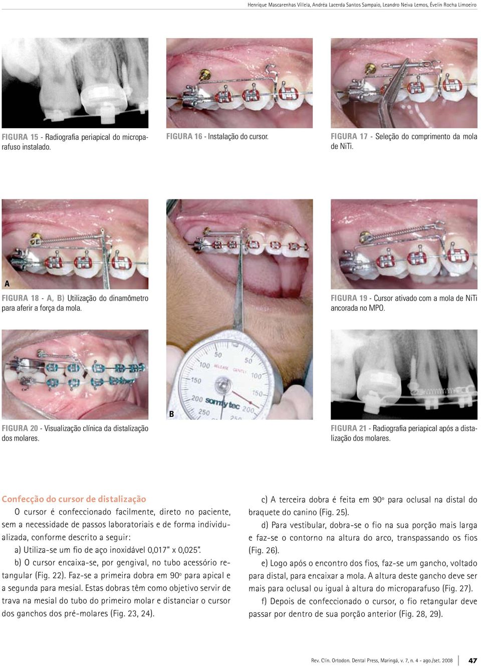 FIGURA 20 - Visualização clínica da distalização dos molares. b FIGURA 21 - Radiografia periapical após a distalização dos molares.
