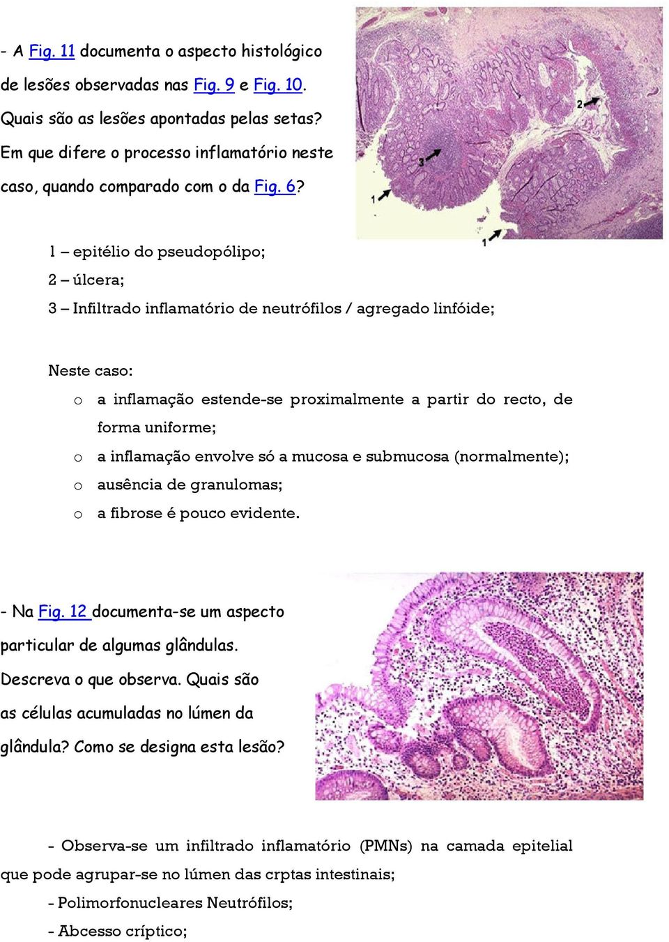 1 epitélio do pseudopólipo; 2 úlcera; 3 Infiltrado inflamatório de neutrófilos / agregado linfóide; Neste caso: o a inflamação estende-se proximalmente a partir do recto, de forma uniforme; o a
