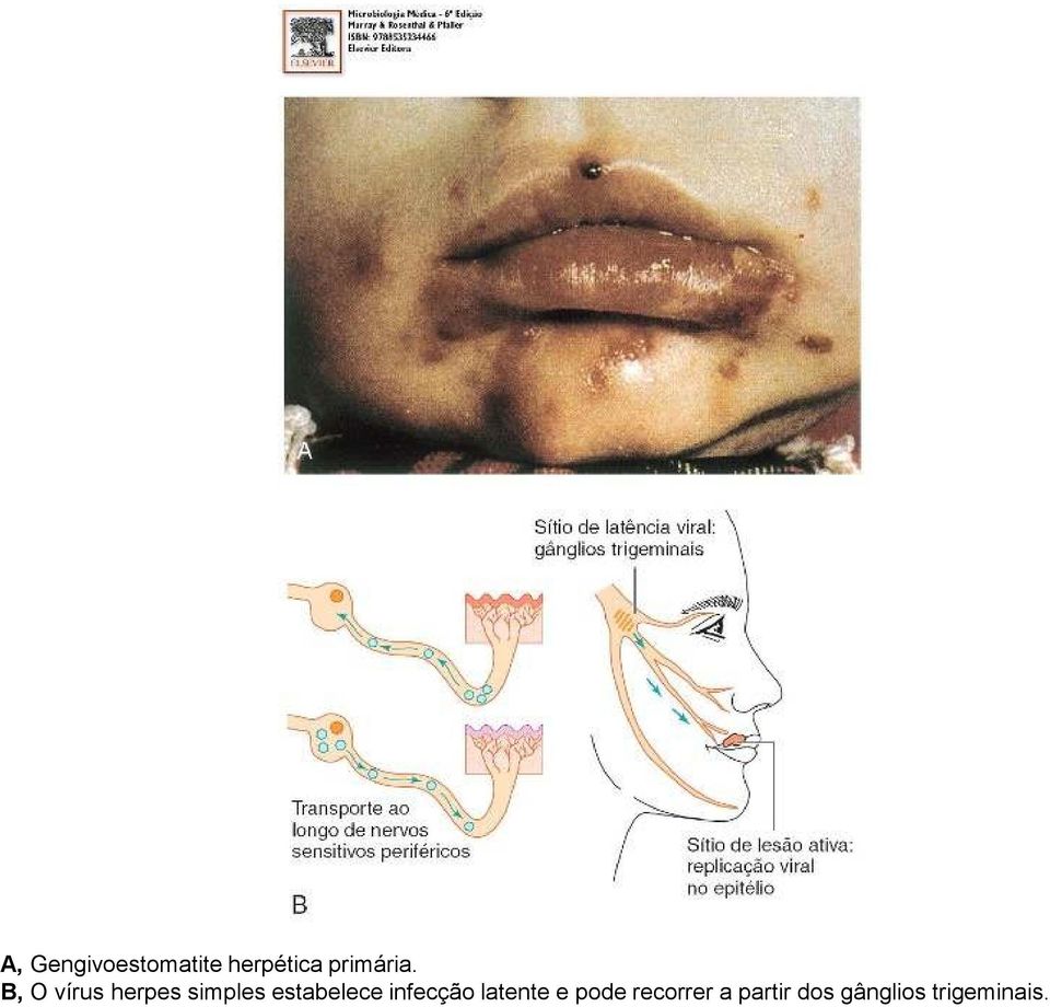 B, O vírus herpes simples estabelece