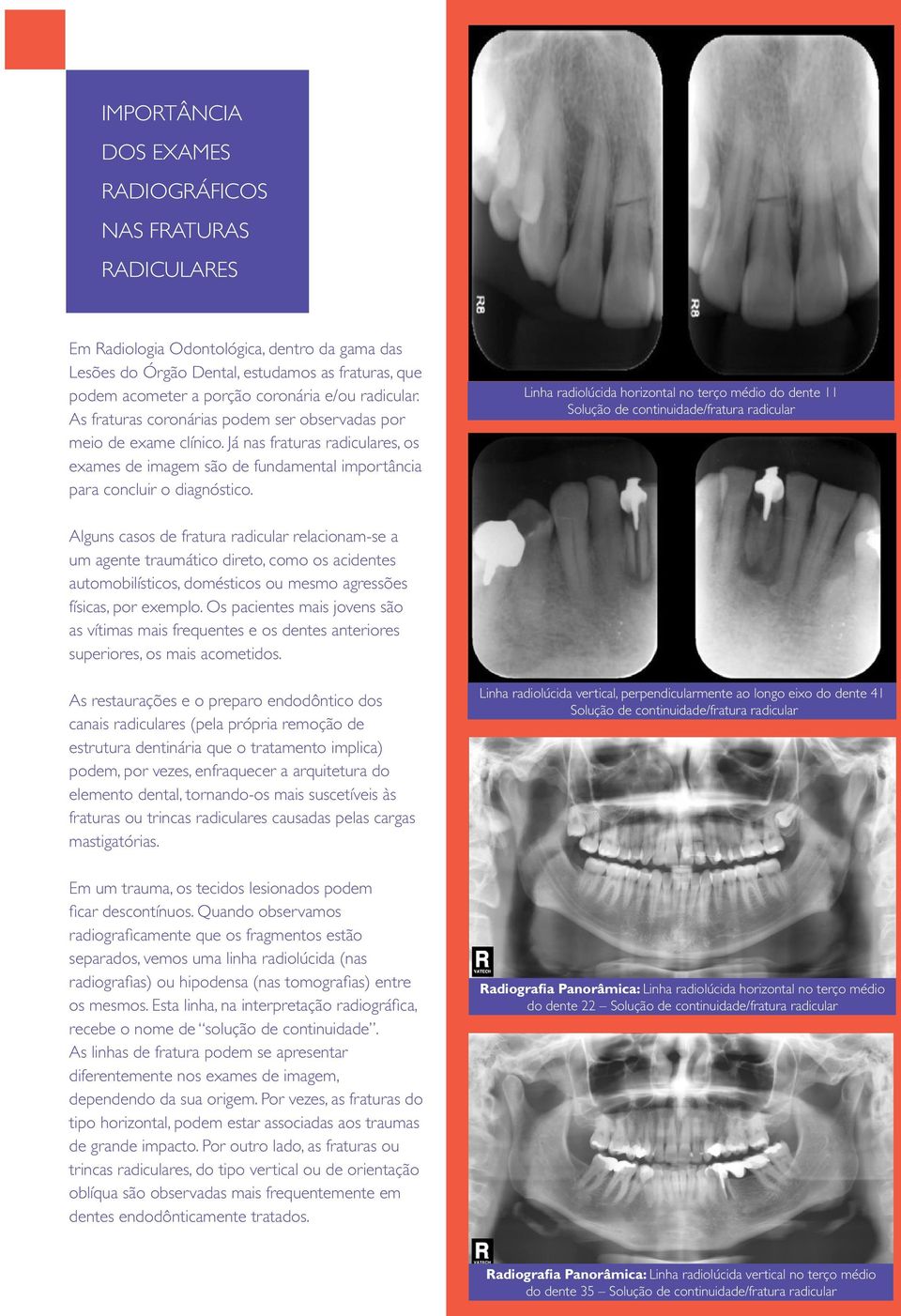Linha radiolúcida horizontal no terço médio do dente 11 Solução de continuidade/fratura radicular Alguns casos de fratura radicular relacionam-se a um agente traumático direto, como os acidentes