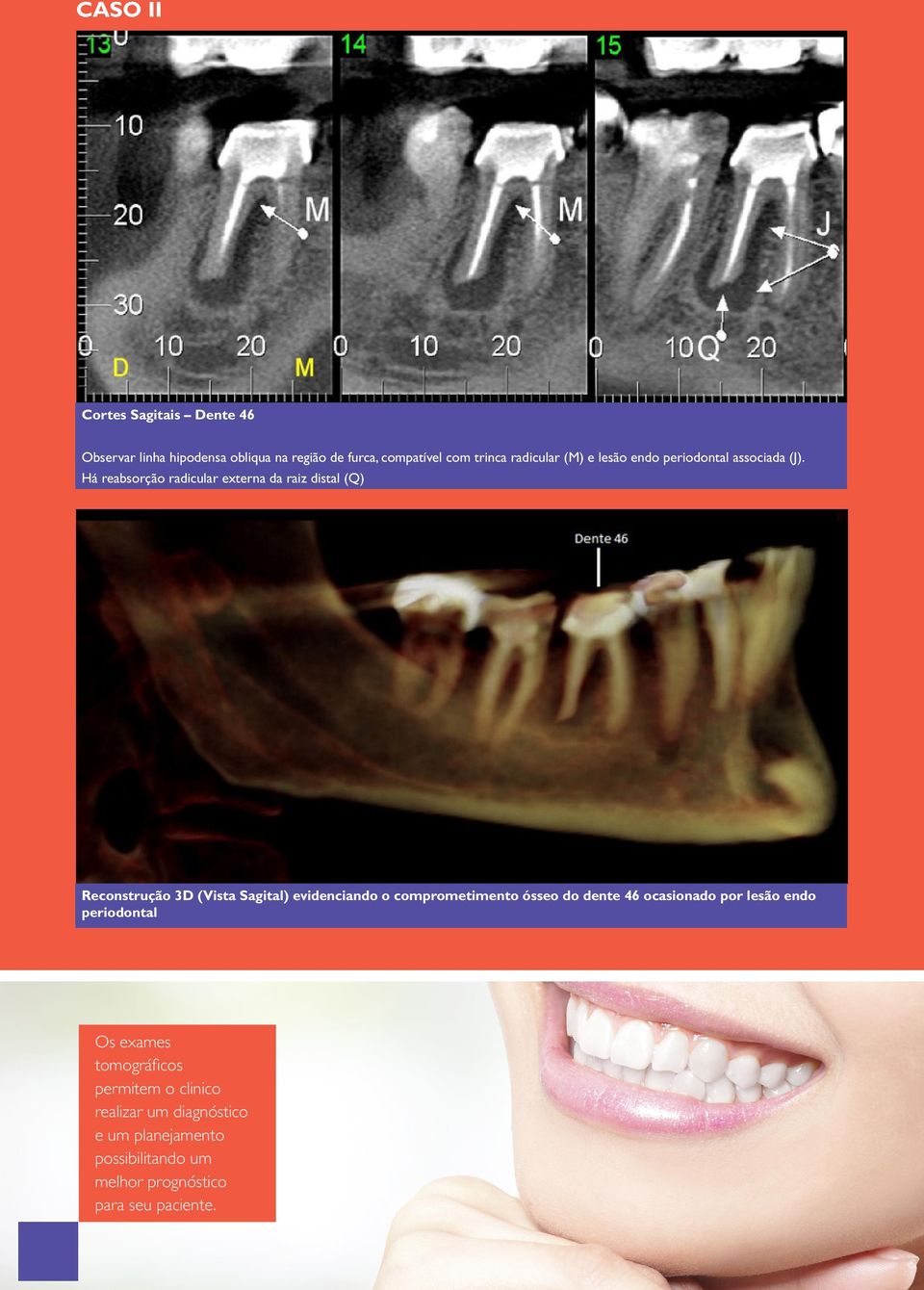 Há reabsorção radicular externa da raiz distal (Q) Reconstrução 3D (Vista Sagital) evidenciando o comprometimento