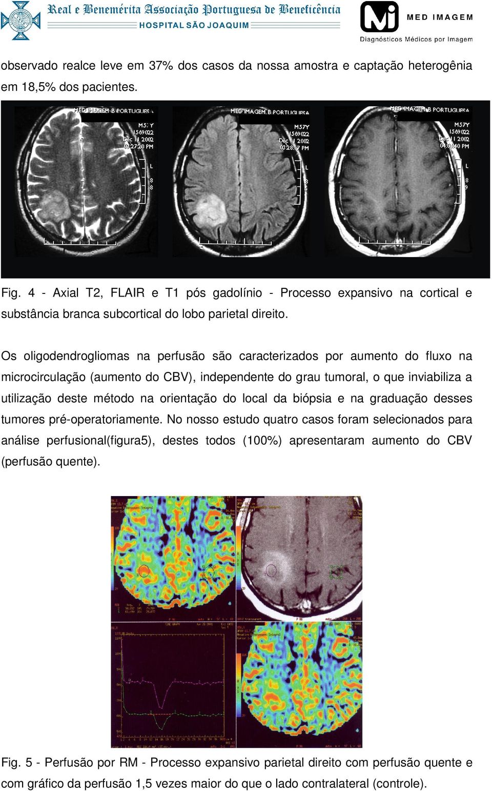 Os oligodendrogliomas na perfusão são caracterizados por aumento do fluxo na microcirculação (aumento do CBV), independente do grau tumoral, o que inviabiliza a utilização deste método na orientação