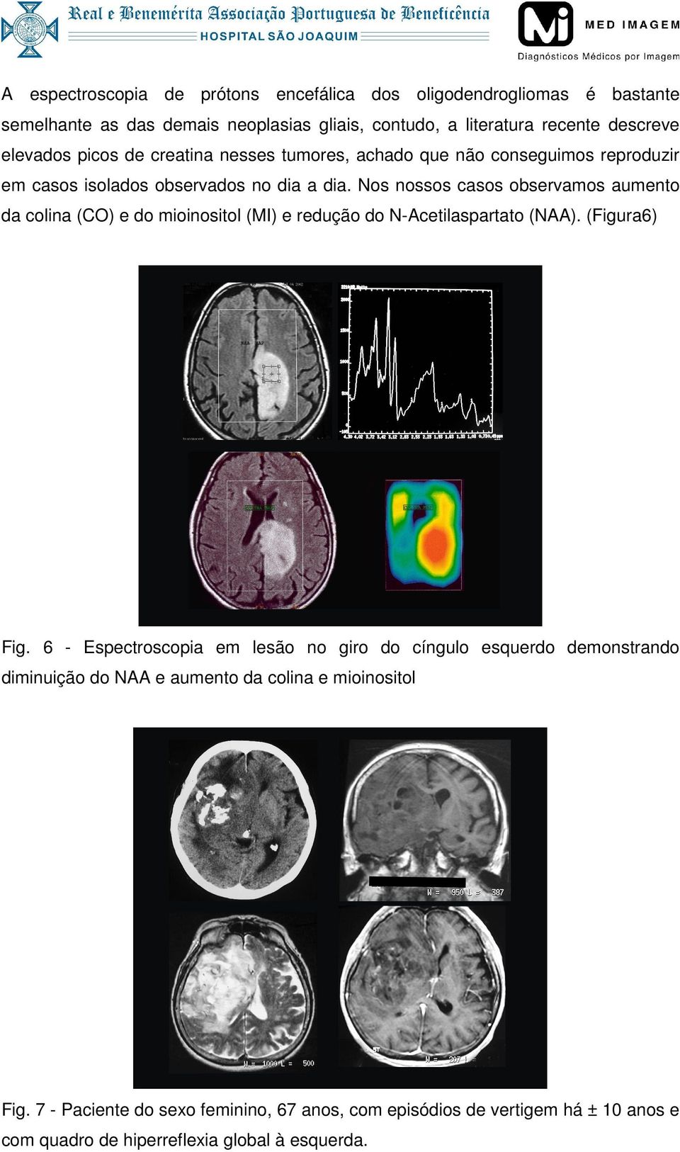 Nos nossos casos observamos aumento da colina (CO) e do mioinositol (MI) e redução do N-Acetilaspartato (NAA). (Figura6) Fig.