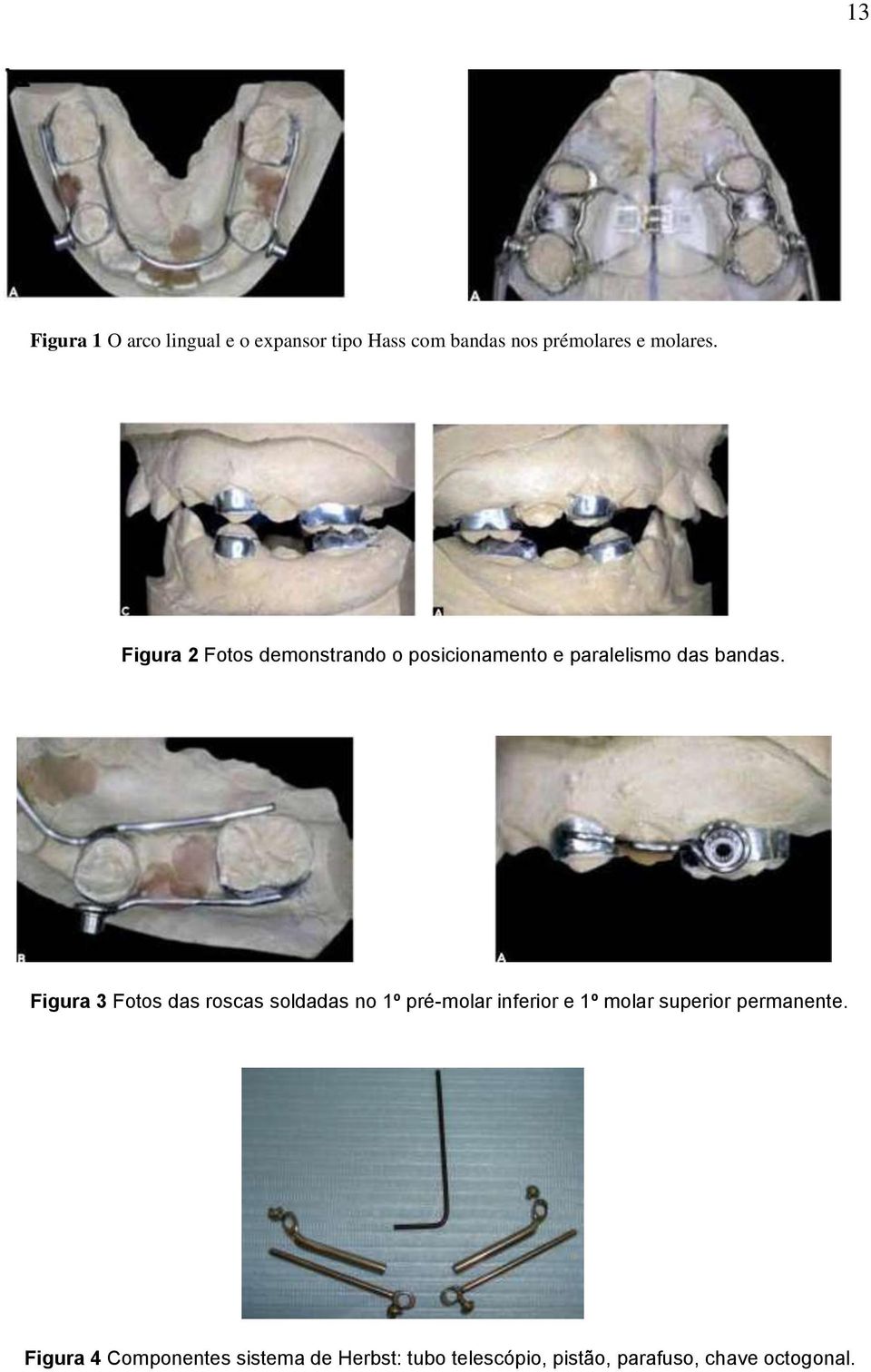 Figura 3 Fotos das roscas soldadas no 1º pré-molar inferior e 1º molar superior