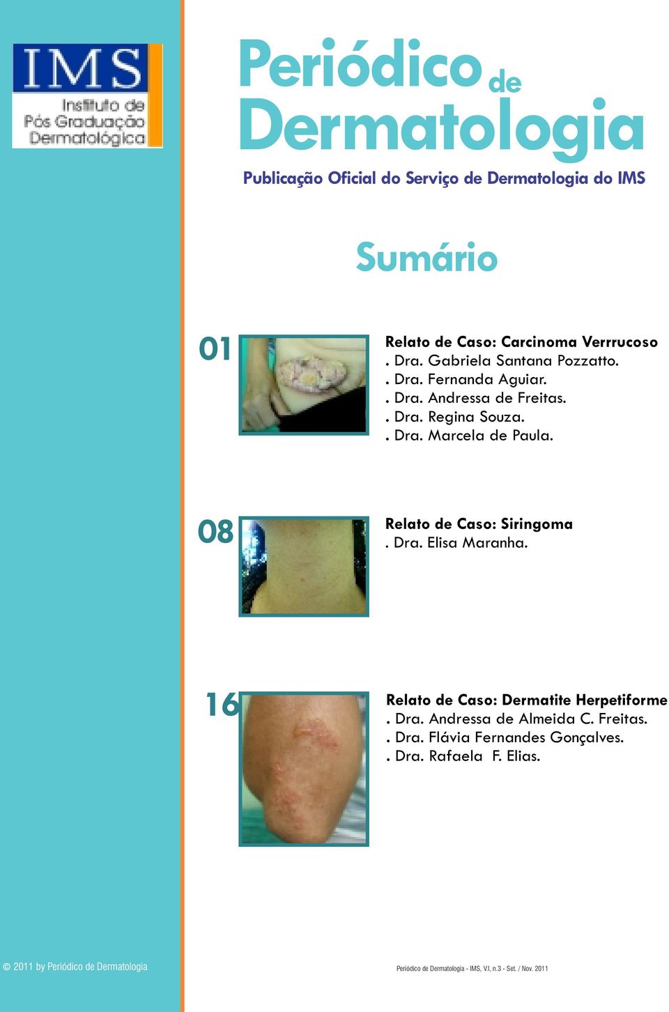 08 Relato de Caso: Siringoma. Dra. Elisa Maranha. 16 Relato de Caso: Dermatite Herpetiforme. Dra. Andressa de Almeida C.