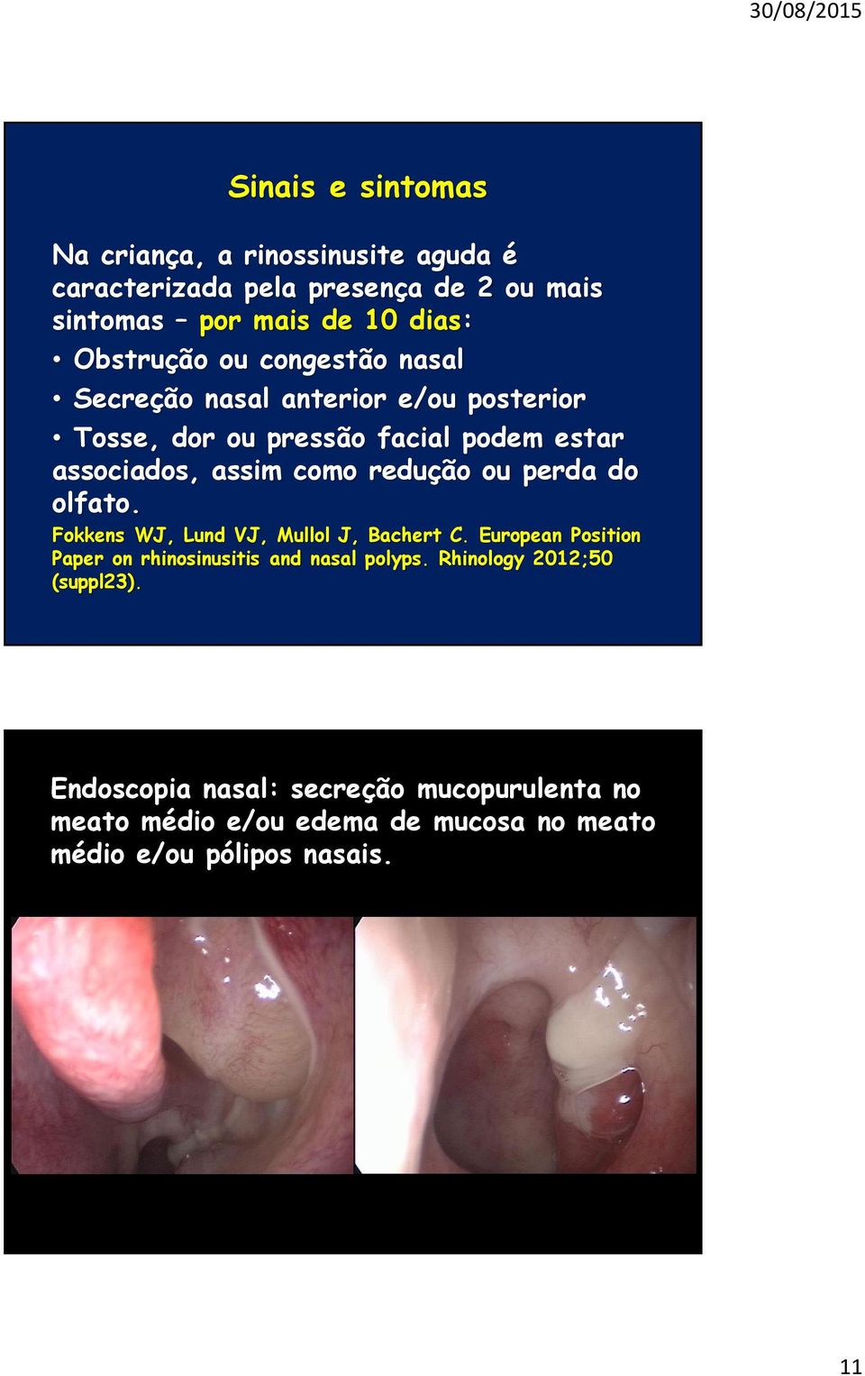 redução ou perda do olfato. Fokkens WJ, Lund VJ, Mullol J, Bachert C. European Position Paper on rhinosinusitis and nasal polyps.