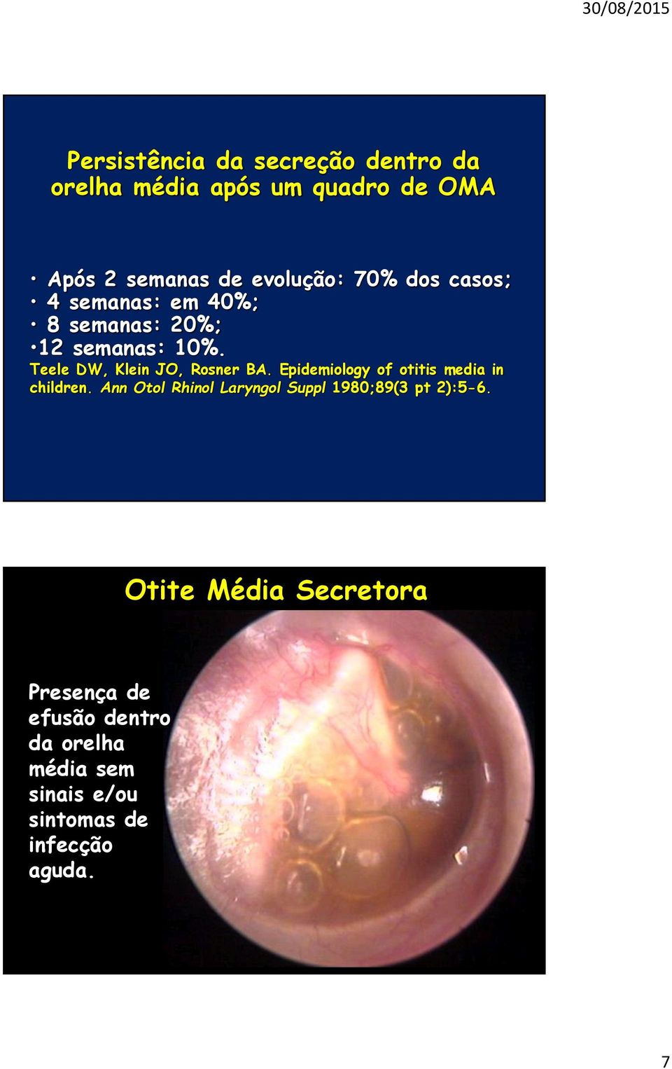 Epidemiology of otitis media in children. Ann Otol Rhinol Laryngol Suppl 1980;89(3 pt 2):5-6.