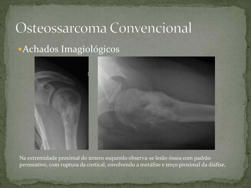 padrão permeativo, com ruptura da cortical,