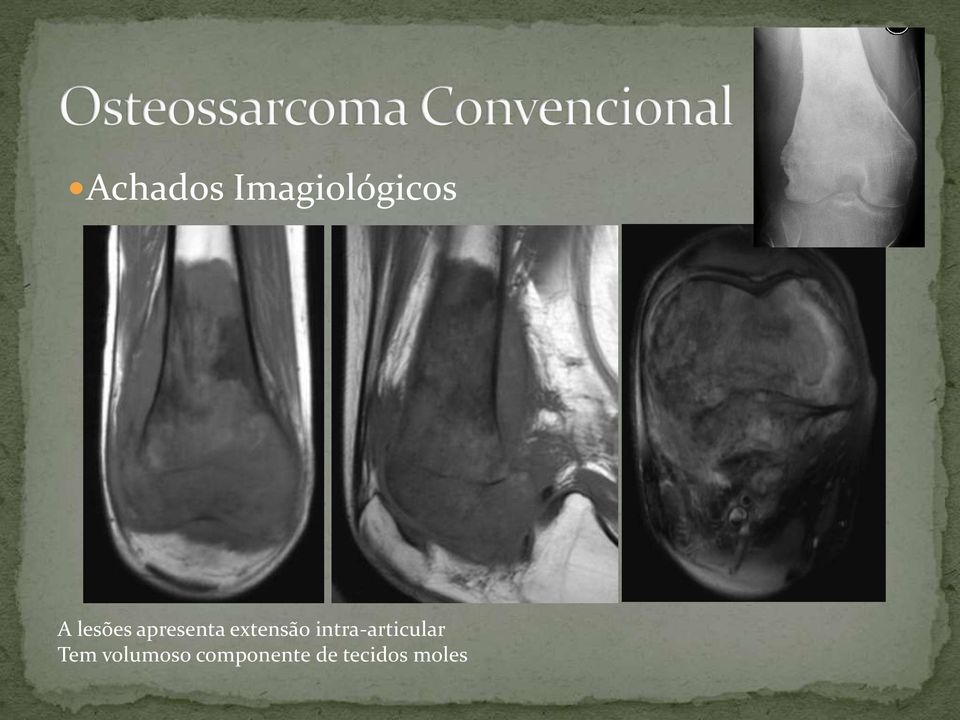 intra-articular Tem