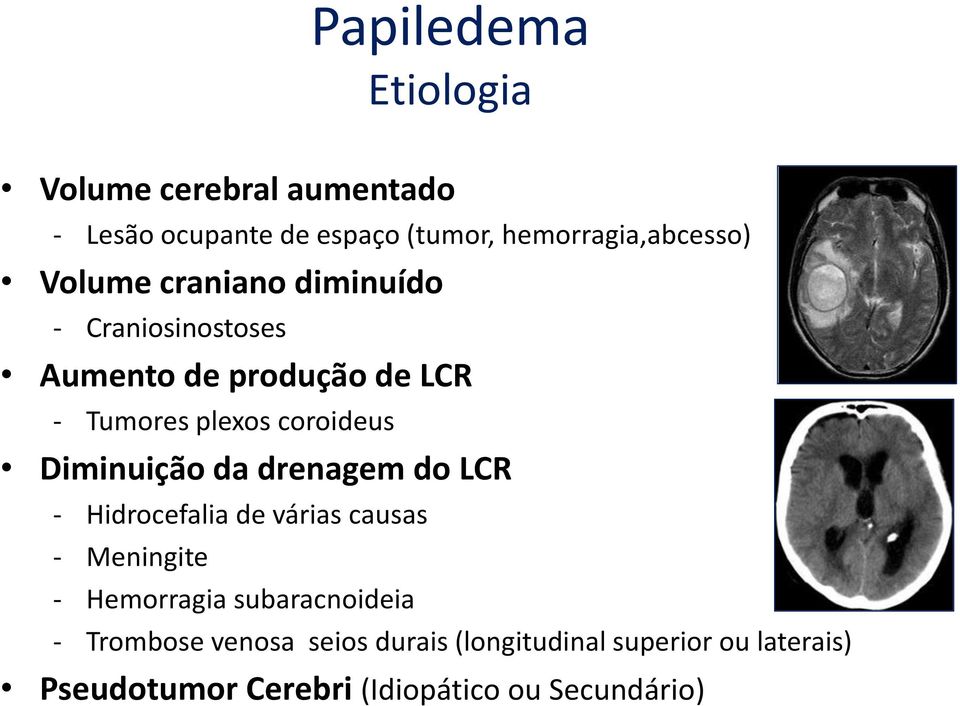 Diminuição da drenagem do LCR - Hidrocefalia de várias causas - Meningite - Hemorragia subaracnoideia -