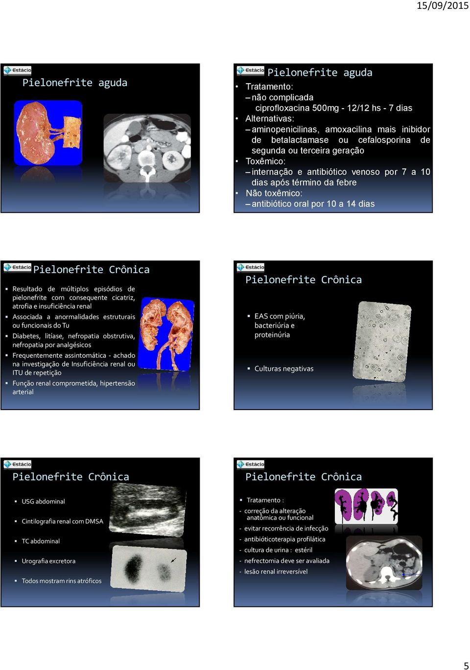 múltiplos episódios de pielonefrite com consequente cicatriz, atrofia e insuficiência renal Associada a anormalidades estruturais ou funcionais do Tu Diabetes, litíase, nefropatia obstrutiva,