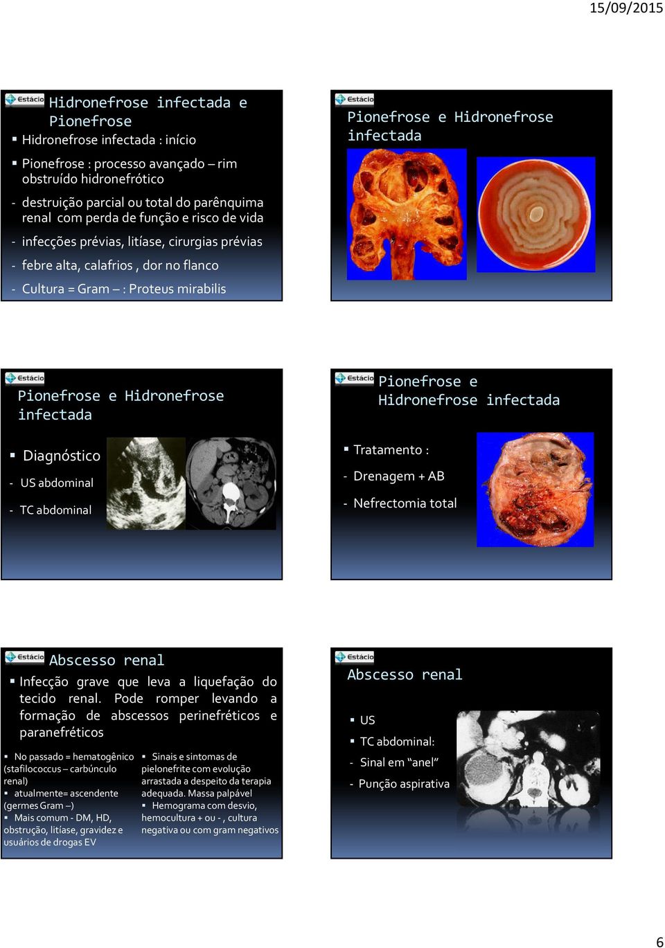 Hidronefrose infectada Diagnóstico - US abdominal - TC abdominal Pionefrose e Hidronefrose infectada Tratamento : - Drenagem + AB - Nefrectomia total Abscesso renal Infecção grave que leva a