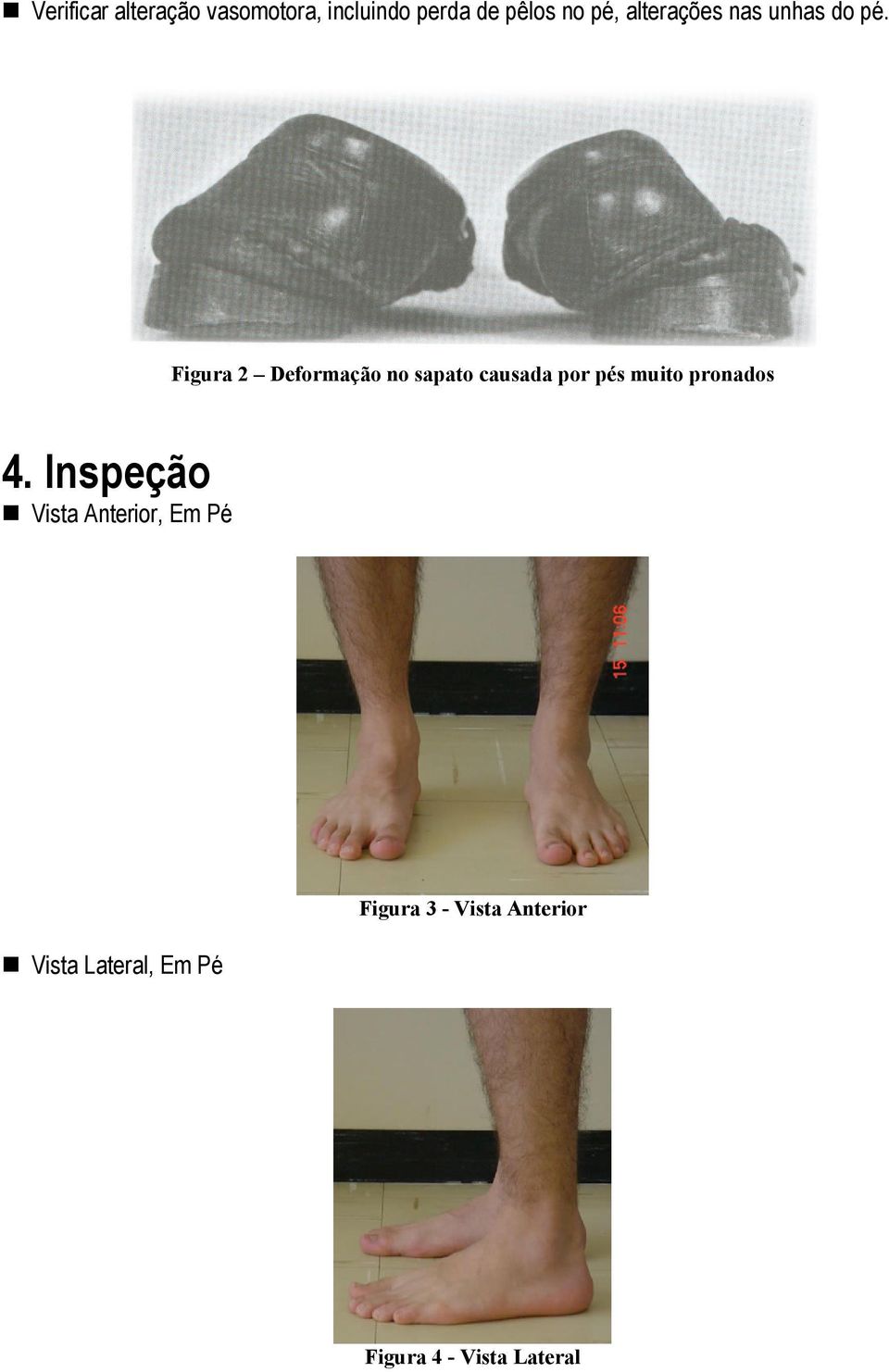 Figura 2 Deformação no sapato causada por pés muito pronados 4.