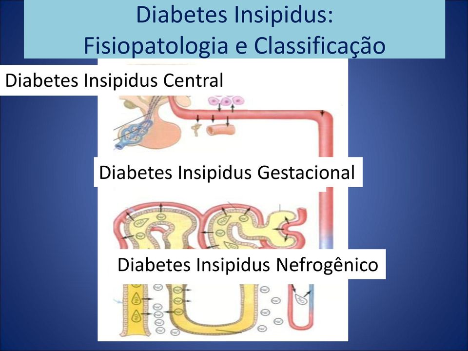 Central Diabetes Insipidus