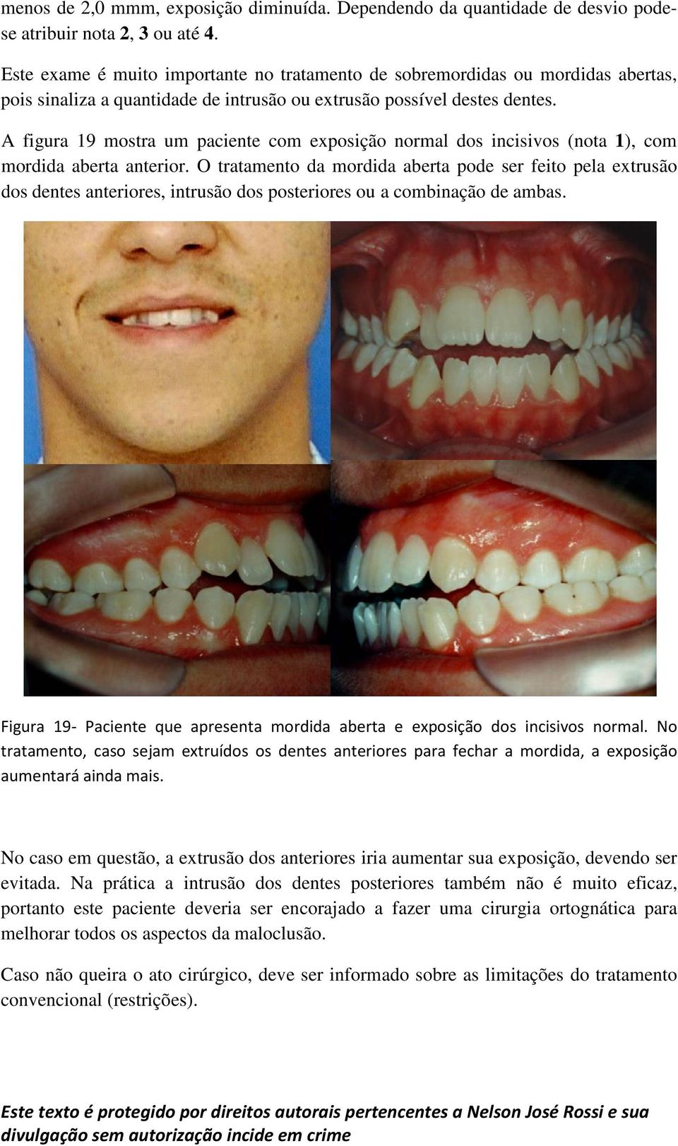 A figura 19 mostra um paciente com exposição normal dos incisivos (nota 1), com mordida aberta anterior.