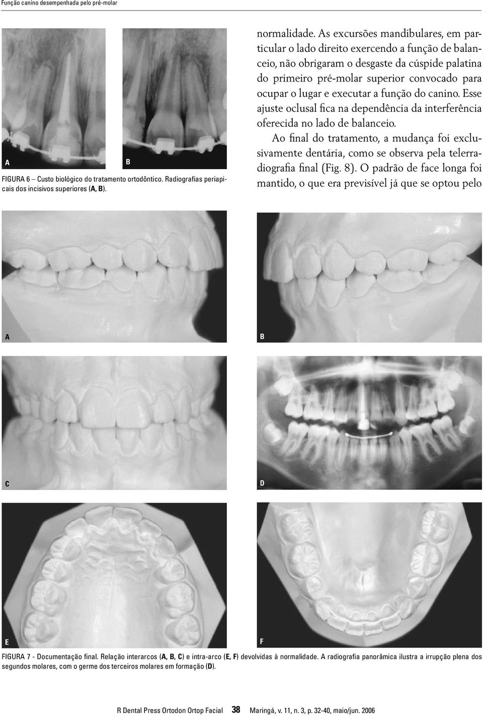 executar a função do canino. Esse ajuste oclusal fica na dependência da interferência oferecida no lado de balanceio.