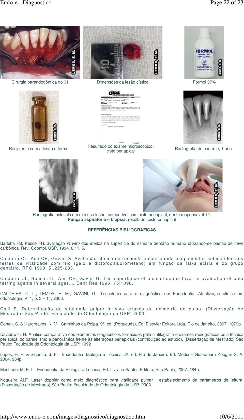 Punção aspiratória e biópsia, resultado: cisto periapical REFERÊNCIAS BIBLIOGRÁFICAS Barletta FB, Pesce FH.