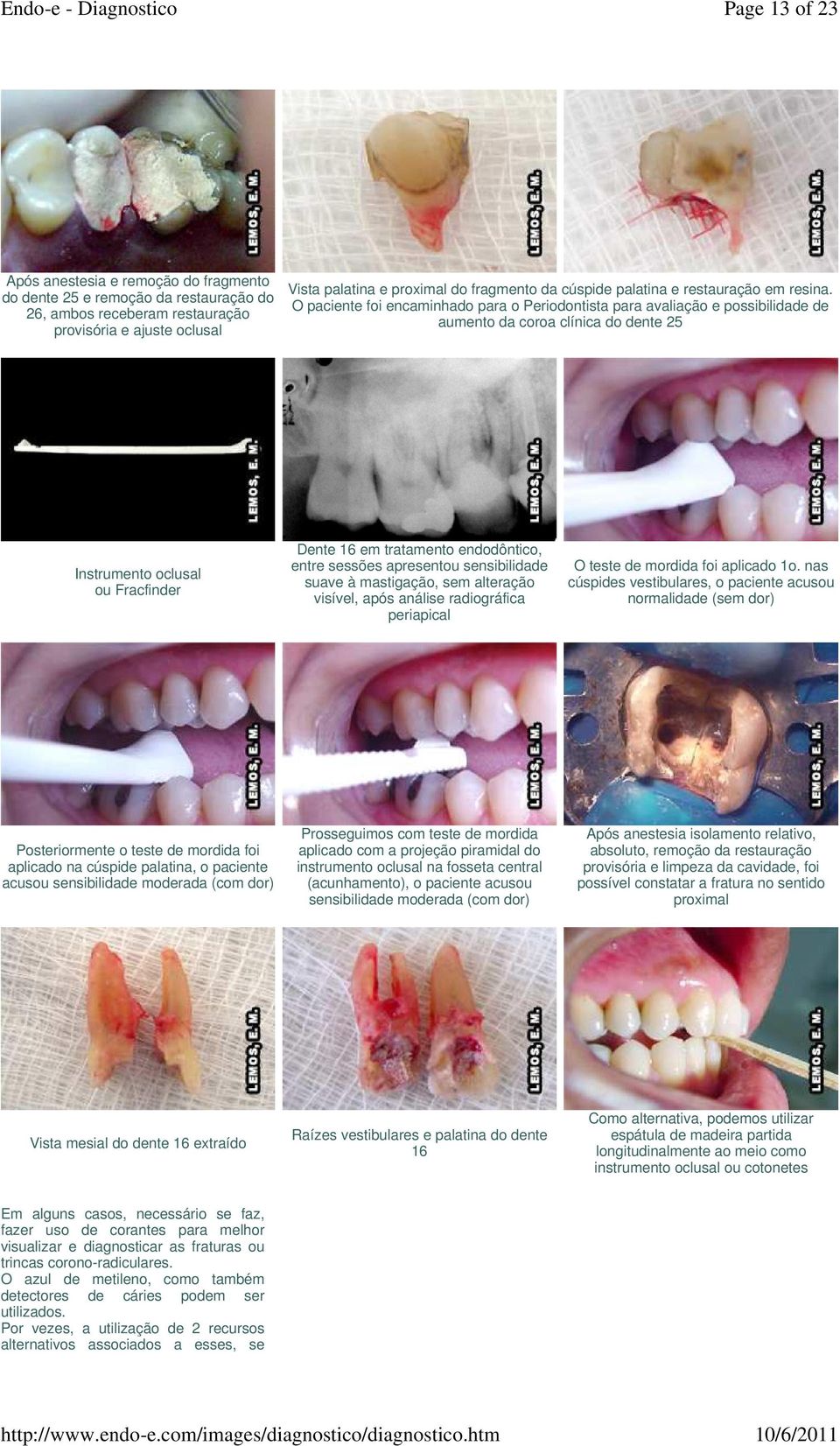 O paciente foi encaminhado para o Periodontista para avaliação e possibilidade de aumento da coroa clínica do dente 25 Instrumento oclusal ou Fracfinder Dente 16 em tratamento endodôntico, entre