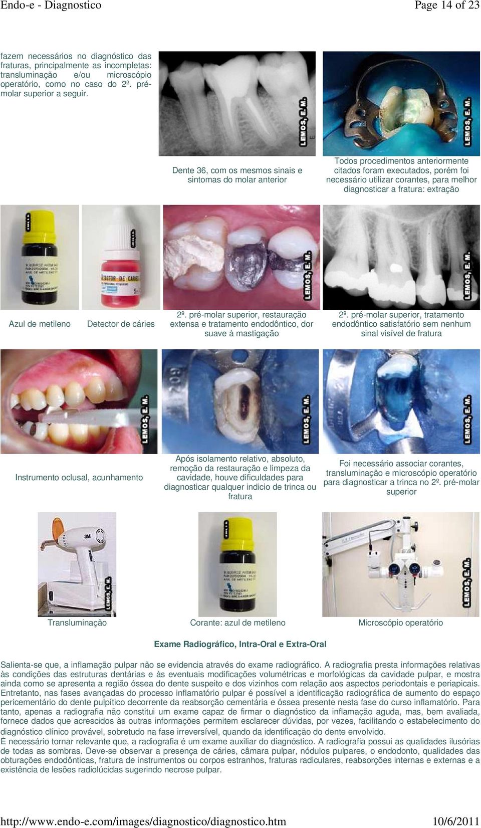 extração Azul de metileno Detector de cáries 2º. pré-molar superior, restauração extensa e tratamento endodôntico, dor suave à mastigação 2º.