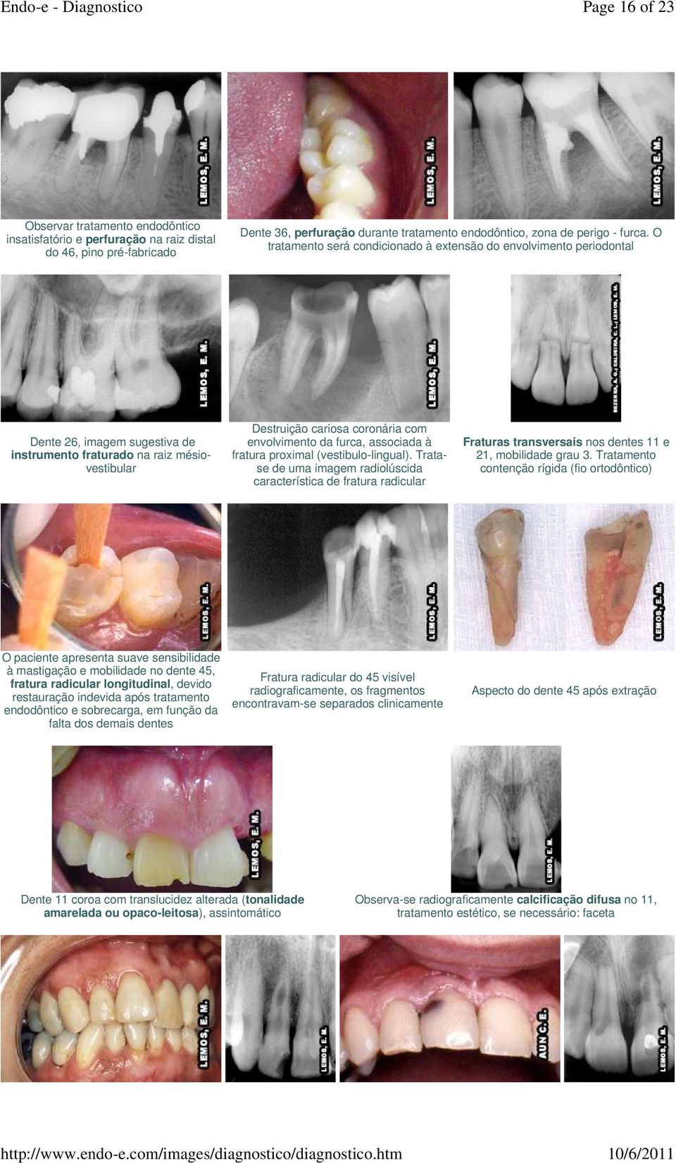 furca, associada à fratura proximal (vestibulo-lingual). Tratase de uma imagem radiolúscida característica de fratura radicular Fraturas transversais nos dentes 11 e 21, mobilidade grau 3.