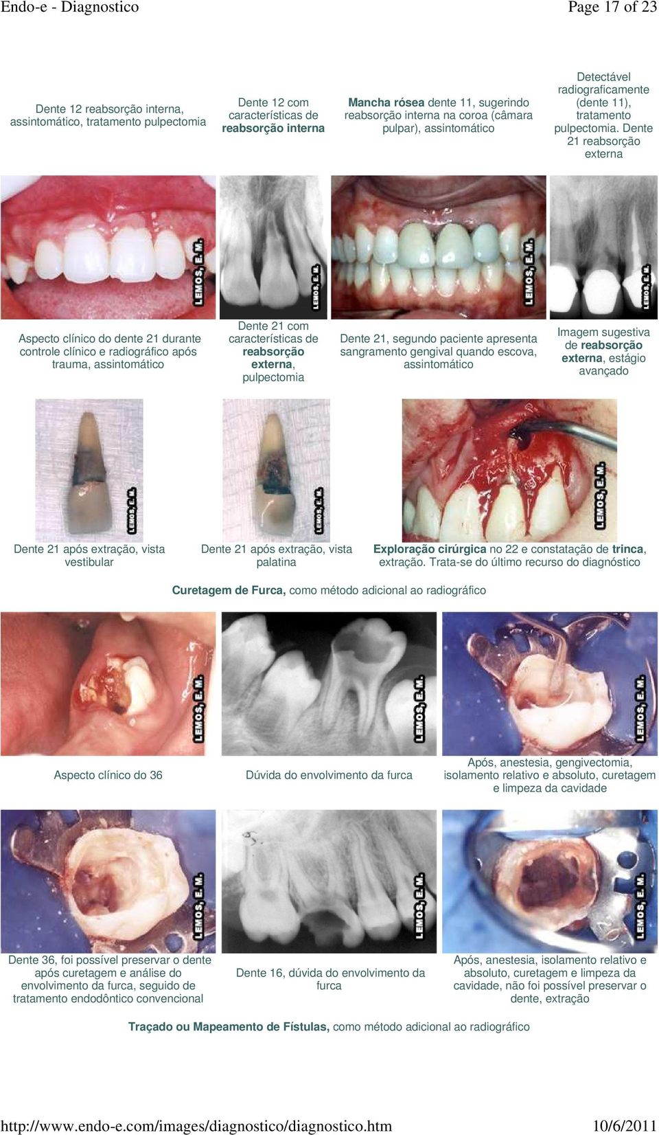 Dente 21 reabsorção externa Aspecto clínico do dente 21 durante controle clínico e radiográfico após trauma, assintomático Dente 21 com características de reabsorção externa, pulpectomia Dente 21,