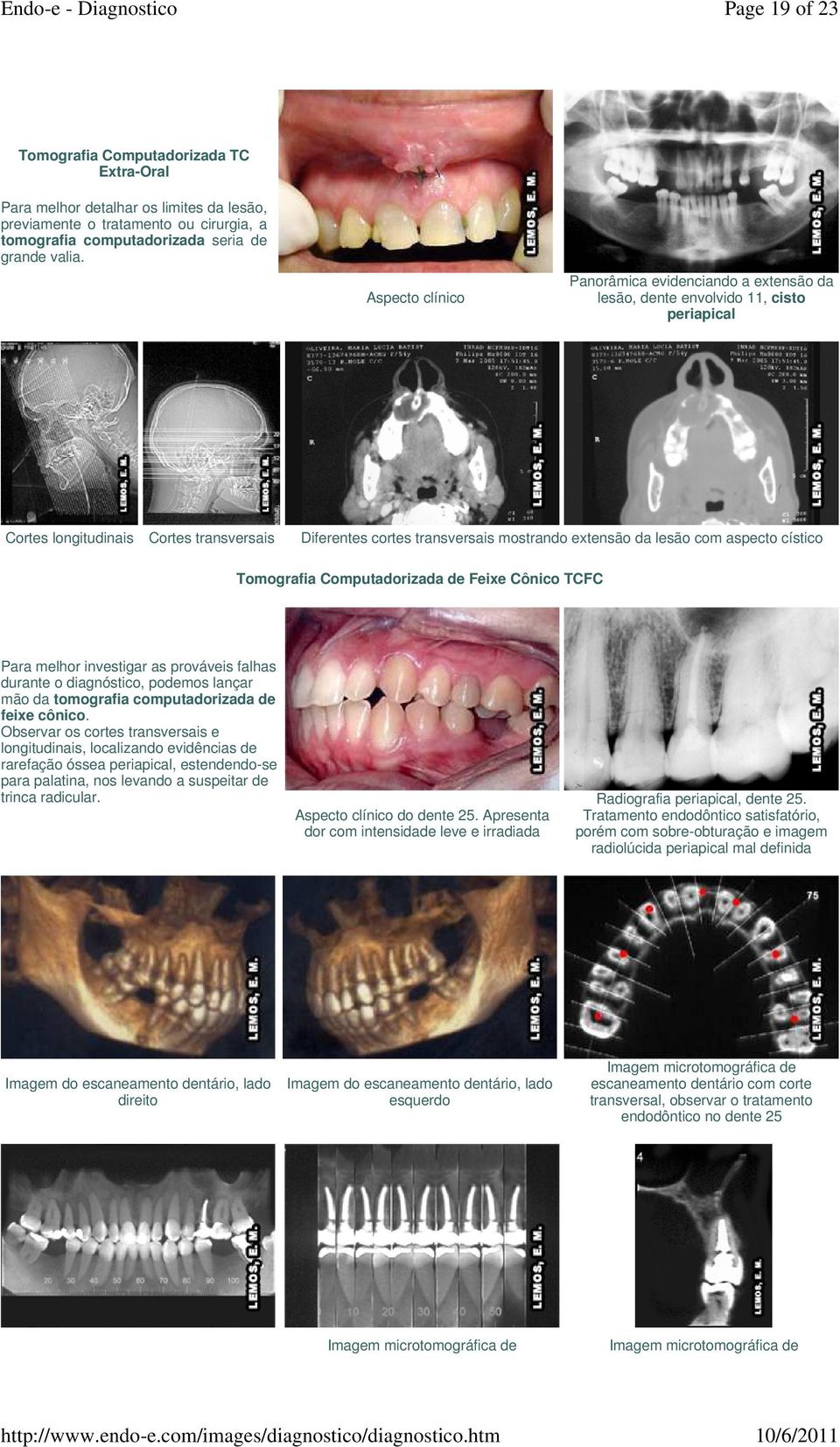 com aspecto cístico Tomografia Computadorizada de Feixe Cônico TCFC Para melhor investigar as prováveis falhas durante o diagnóstico, podemos lançar mão da tomografia computadorizada de feixe cônico.