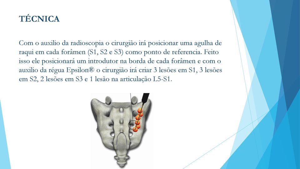 Feito isso ele posicionará um introdutor na borda de cada forâmen e com o auxilio da