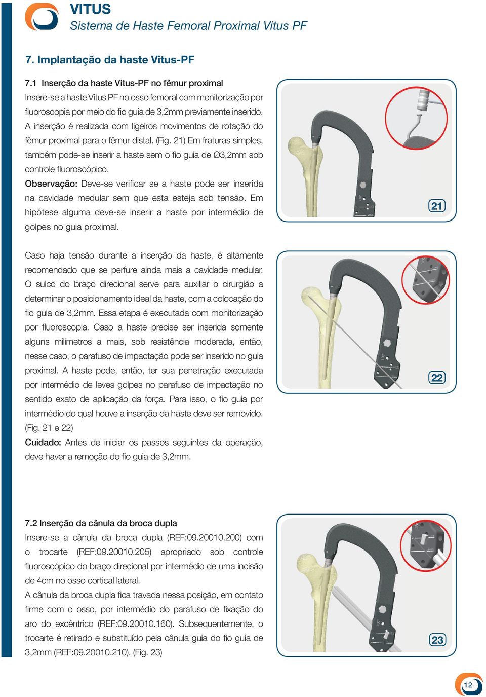 A inserção é realizada com ligeiros movimentos de rotação do fêmur proximal para o fêmur distal. (Fig.