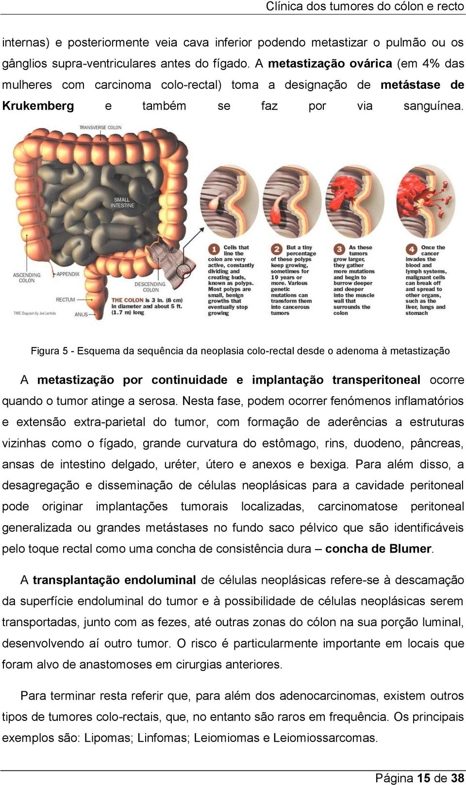 Figura 5 - Esquema da sequência da neoplasia colo-rectal desde o adenoma à metastização A metastização por continuidade e implantação transperitoneal ocorre quando o tumor atinge a serosa.