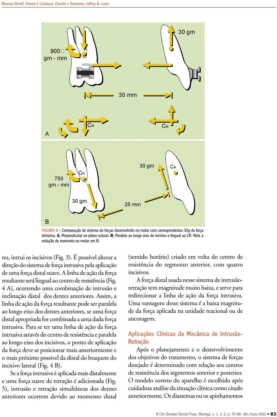 , Paralela ao longo eixo do incisivo e lingual ao. Note a redução do momento no molar em. res, intrui os incisivos (Fig. 3).
