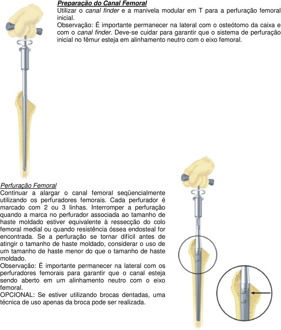 Deve-se cuidar para garantir que o sistema de perfuração inicial no fêmur esteja em alinhamento neutro com o eixo femoral.