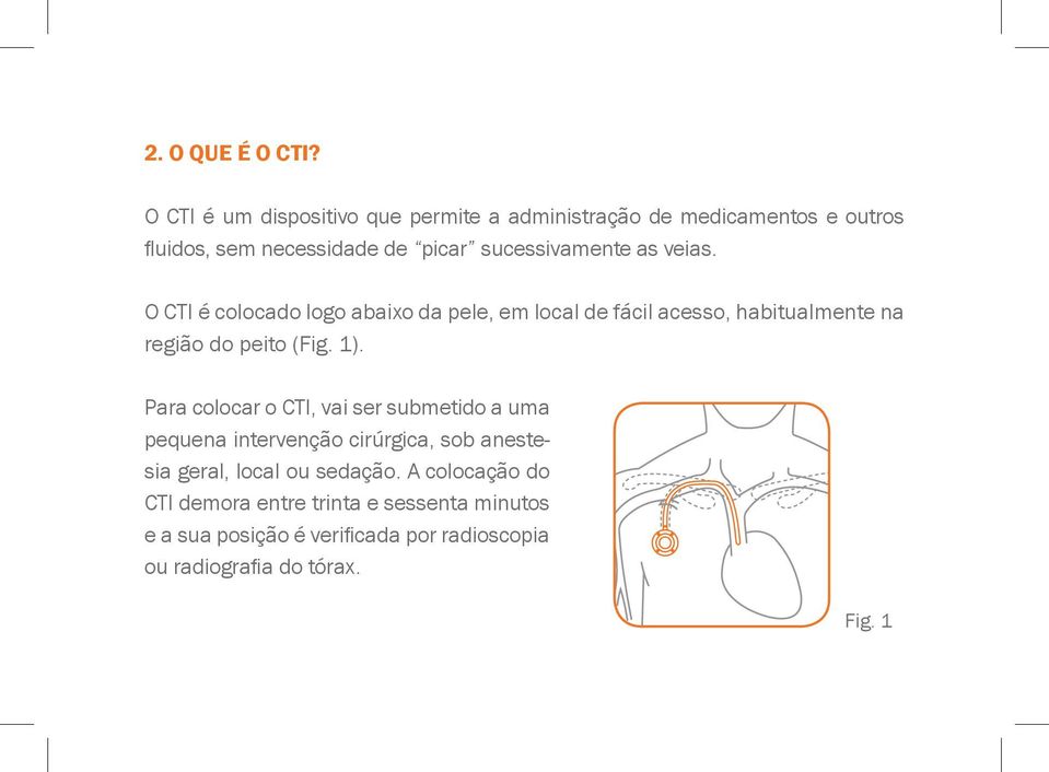 as veias. O CTI é colocado logo abaixo da pele, em local de fácil acesso, habitualmente na região do peito (Fig. 1).