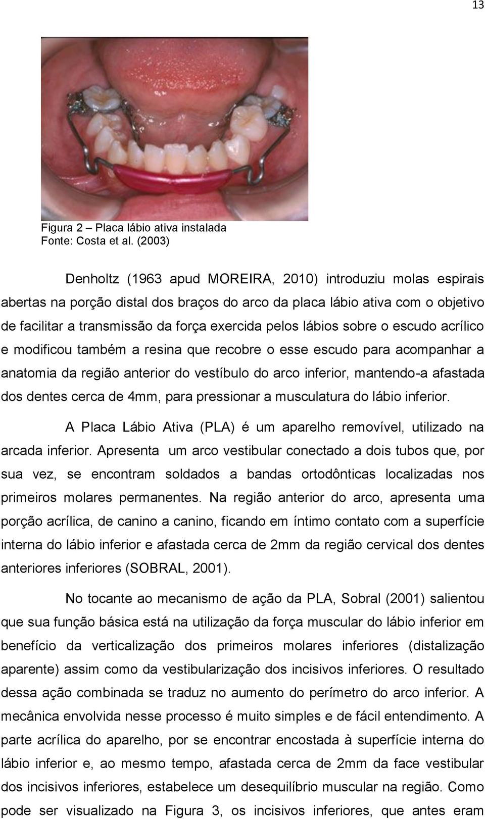 lábios sobre o escudo acrílico e modificou também a resina que recobre o esse escudo para acompanhar a anatomia da região anterior do vestíbulo do arco inferior, mantendo-a afastada dos dentes cerca