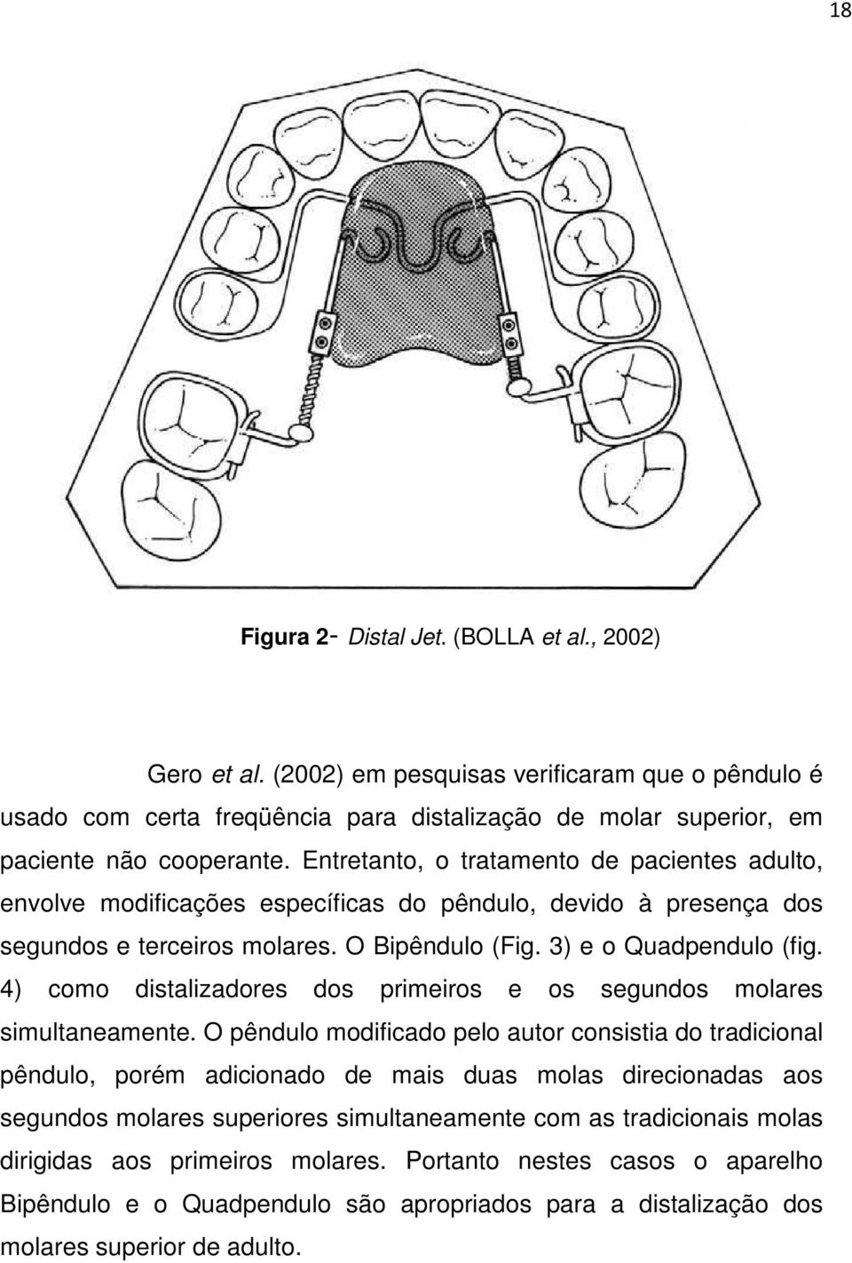 4) como distalizadores dos primeiros e os segundos molares simultaneamente.